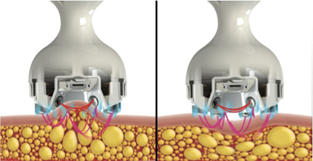 rf skin tightening 2.jpg