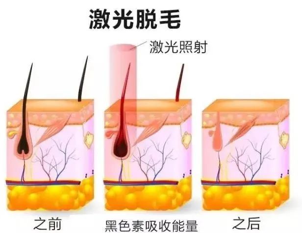 808半導(dǎo)體激光冰點(diǎn)無痛脫毛儀.jpg