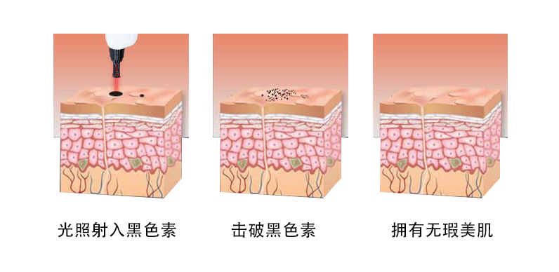 臺(tái)式無(wú)創(chuàng)洗眉機(jī).2.png